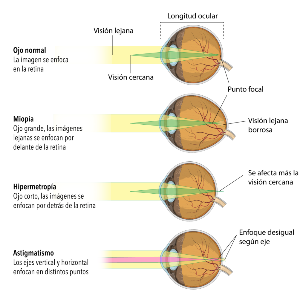 Representação ilustrada dos problemas citados (visão normal x miopia, astigmatismo e hipermetropia)
